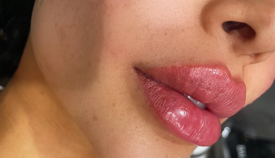 Russian lip filler technique Dubai