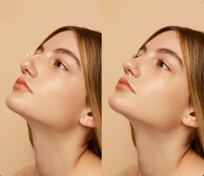 Non-surgical nose enhancement before and after results showing a smoother nasal bridge at Paramy Polyclinic Dubai