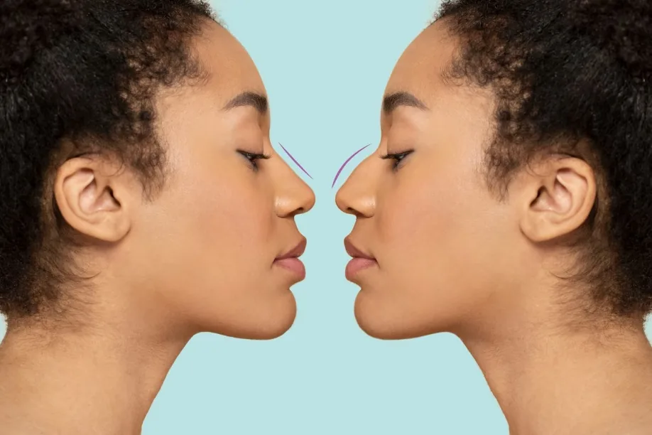 Before and after comparison showing how non-surgical rhinoplasty can smooth a mild nasal bump in Dubai
