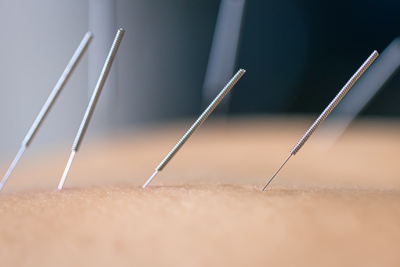 1. Acupuncture Helps Relieve Chronic Pain