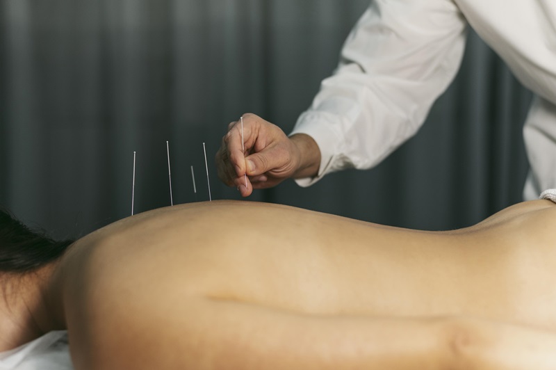 Benefits of Acupuncture