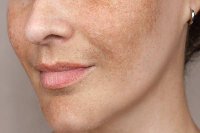 Understanding Melasma and Hyperpigmentation