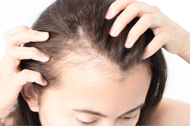 Treatment Options for Postpartum Hair Loss