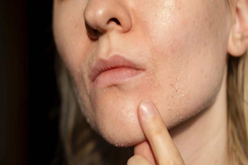 Dry Skin