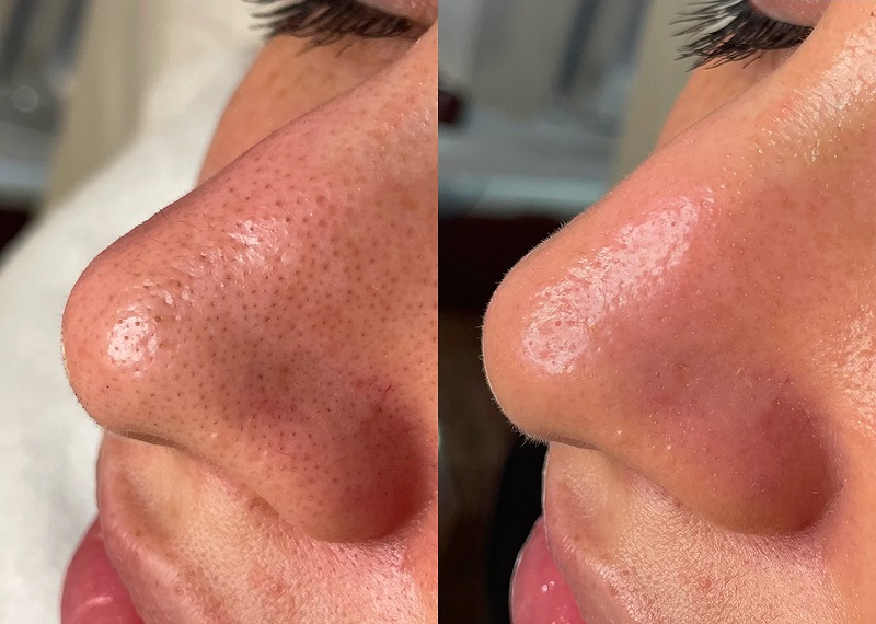 HydraFacial Before and After 1