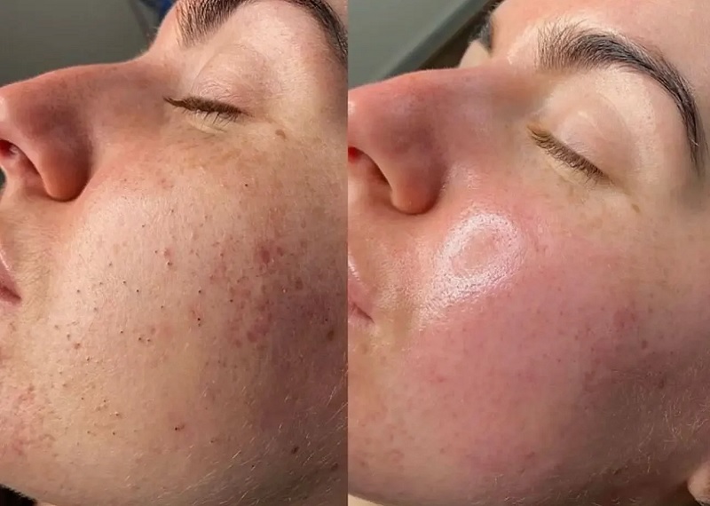 HydraFacial Before and After 2