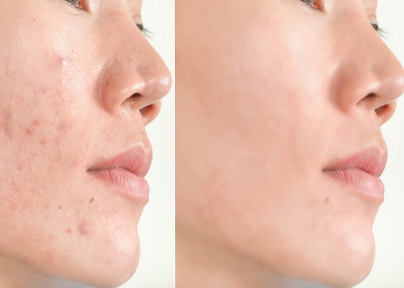HydraFacial Before and After 3