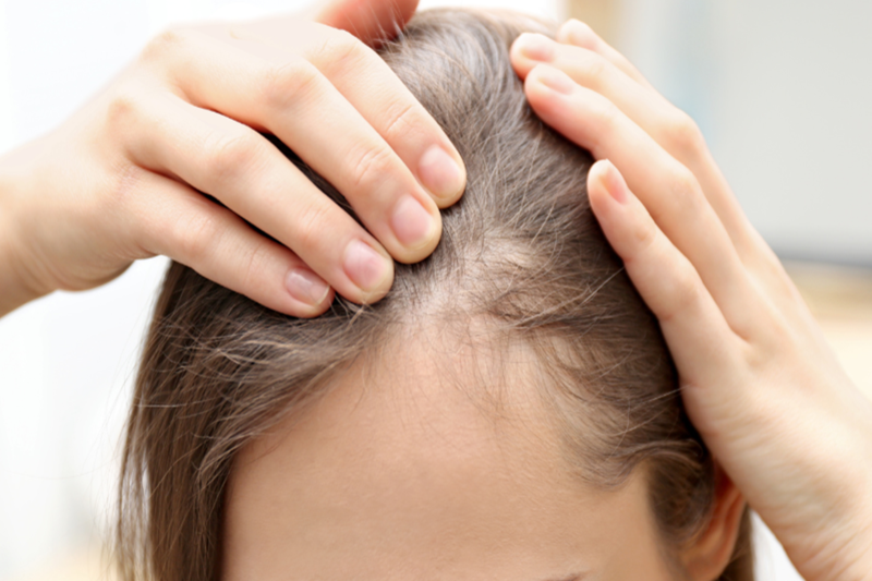 Understanding Female Hair Loss