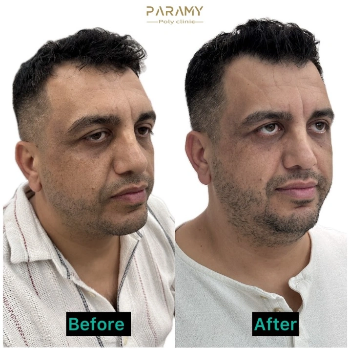 GHK-Cu Peptide Pen Dubai for Hair Loss