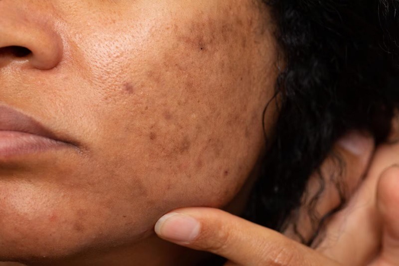 Hyperpigmentation: What It Is, Causes, and Treatment