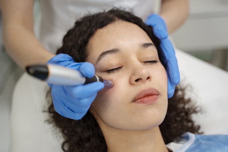 Laser Pigmentation Removal
