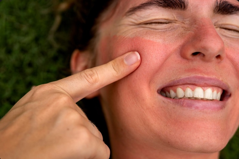 Sun Exposure & UV Damage