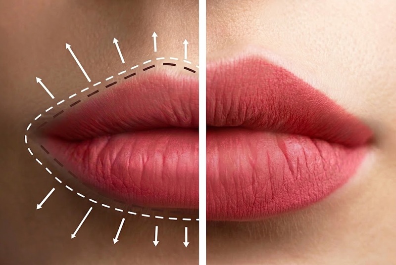 Lip Fillers vs. Lip Implants – Which Is Better?