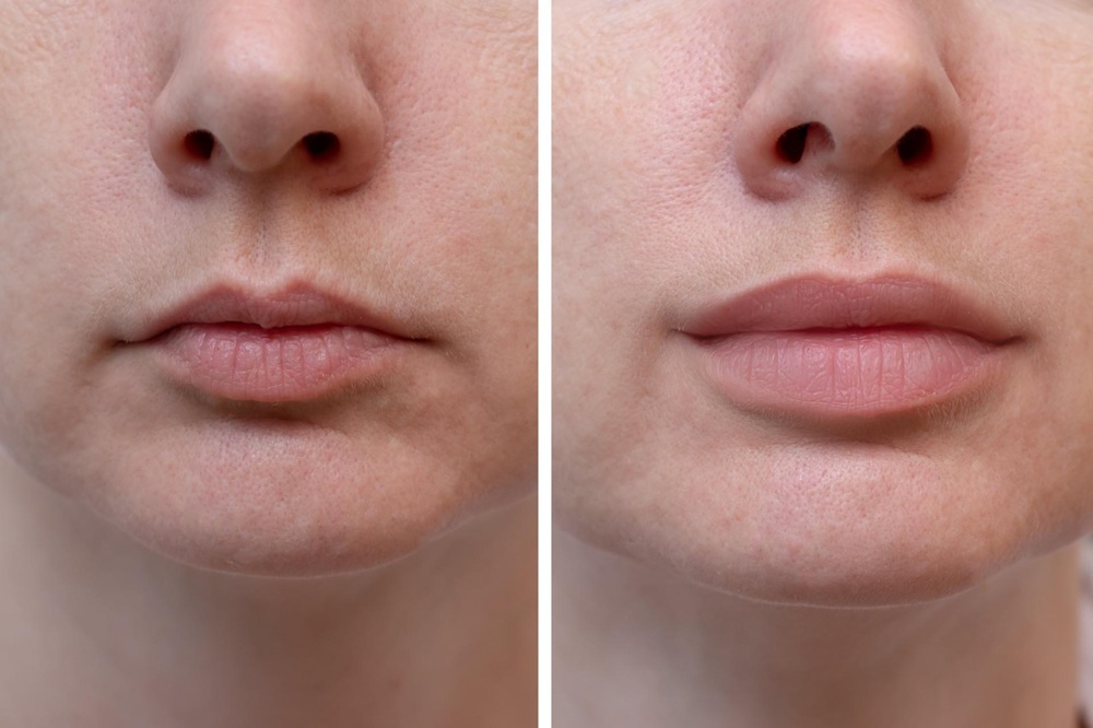Lip Filler