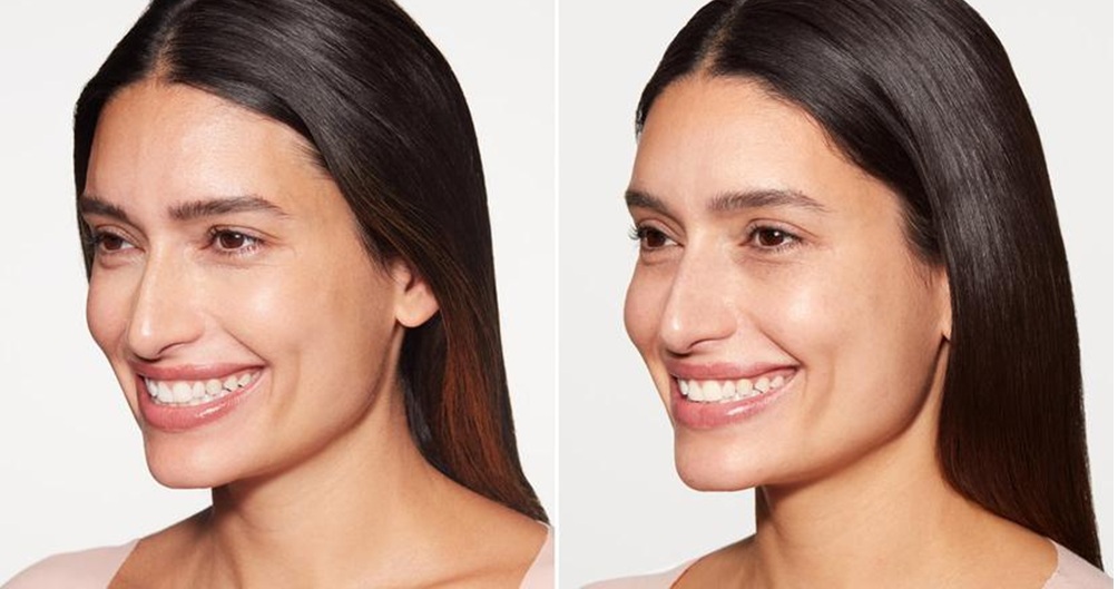 Natural-looking Sculptra results