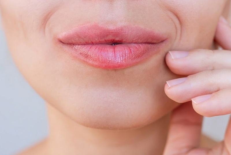 RHA fillers are designed with flexibility and dynamic facial movement in mind