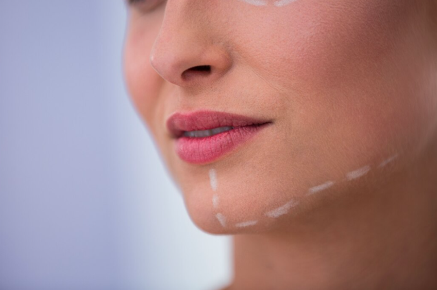 How Many Units of Botox Are Needed for Masseter?