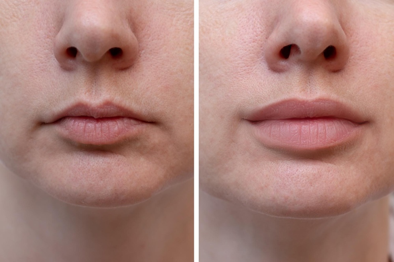 What Is Lip Filler?