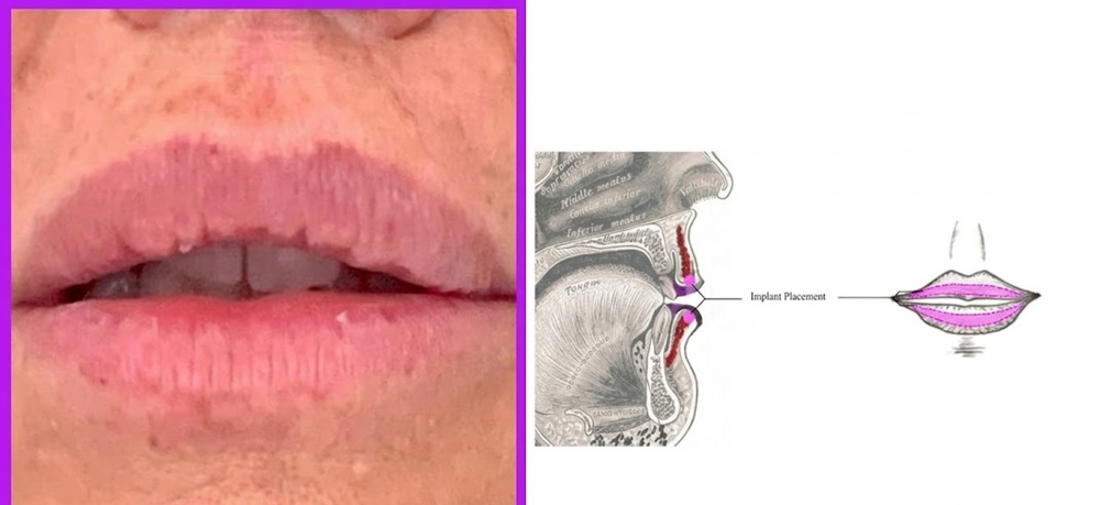 Who Is a Good Candidate for Lip Fillers?