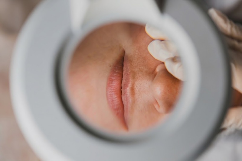 Lip implants are designed to provide much longer-lasting results