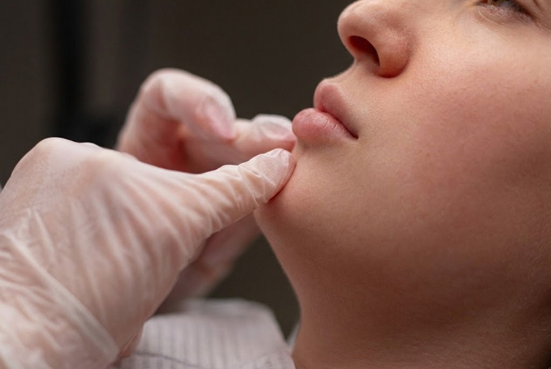 Belotero Balance is a soft HA filler that can be useful for delicate correction around the mouth