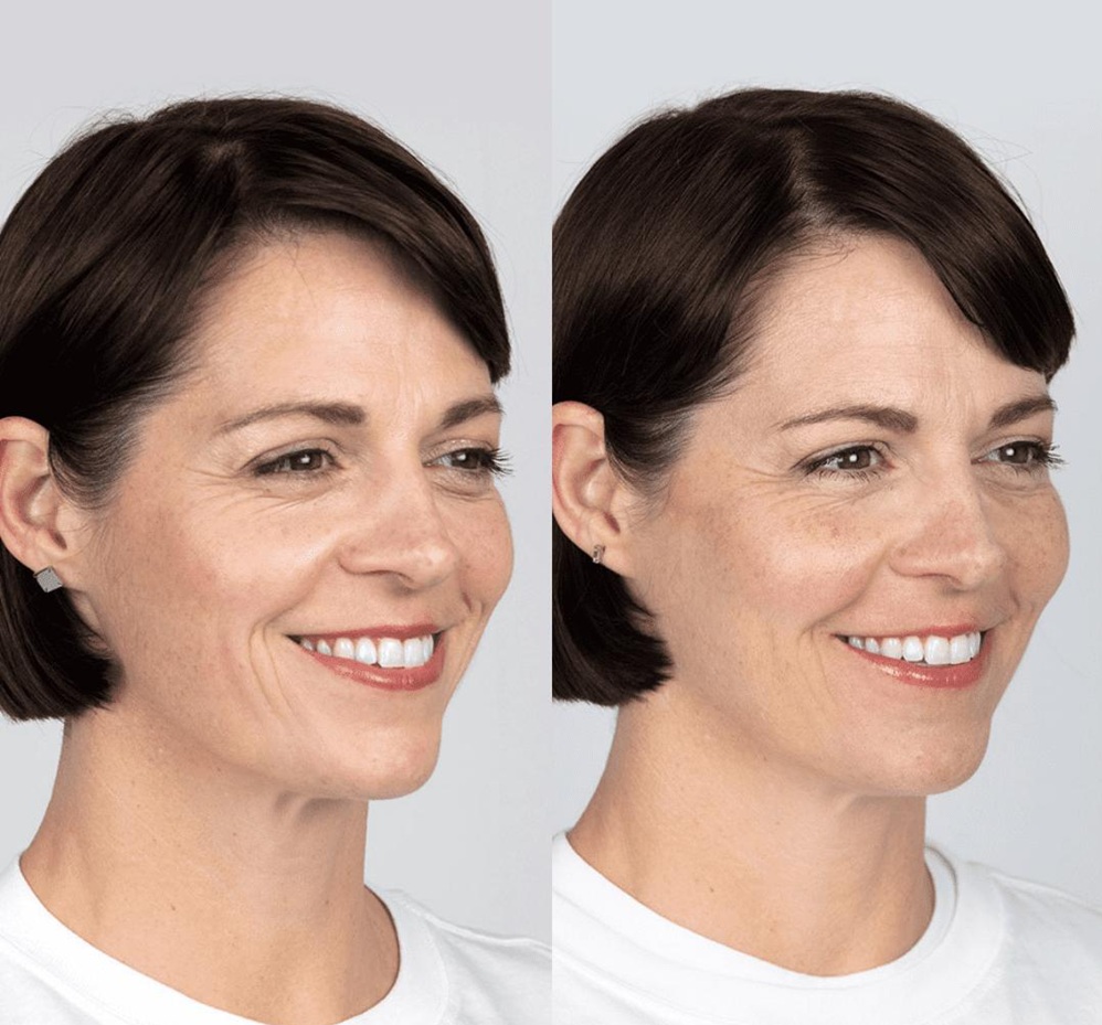 What Is Sculptra Used For?