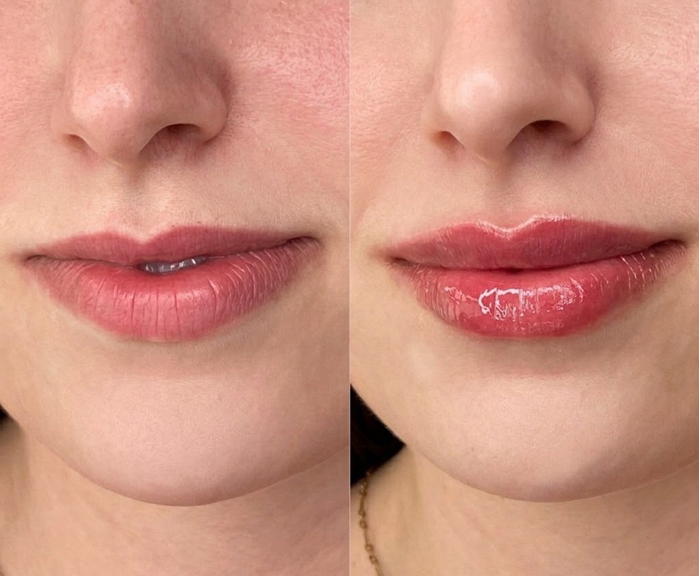 Lip Flip vs. Lip Filler: Which Gives More Volume?