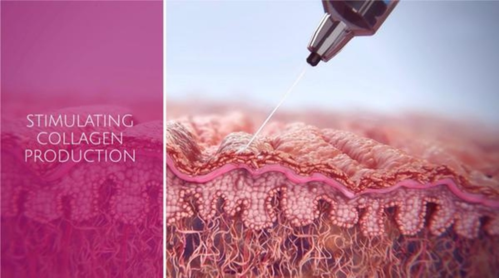 What Is Sculptra?