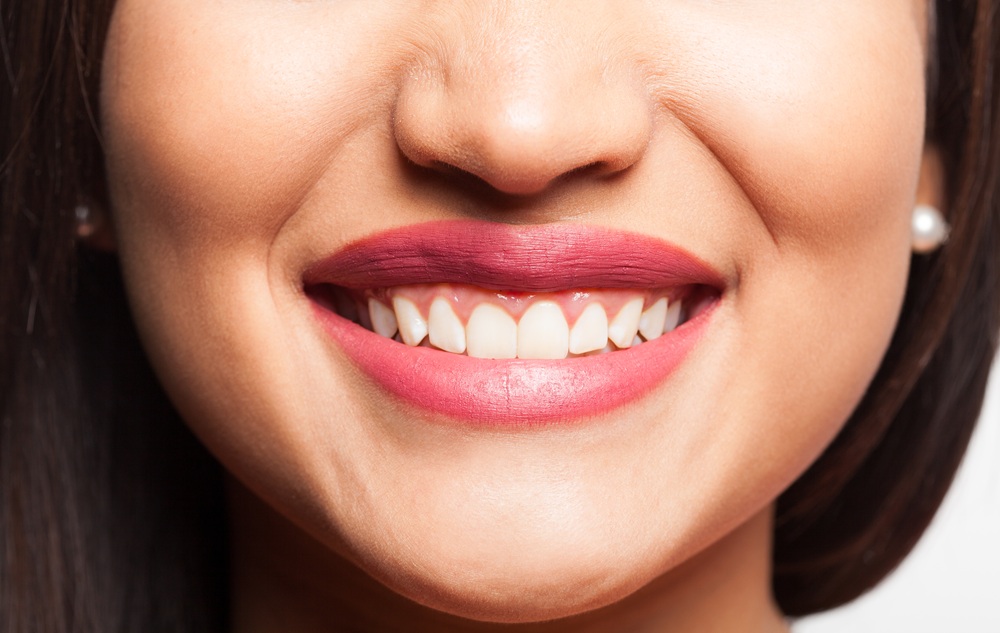 Lip Flip vs. Lip Filler for a Gummy Smile