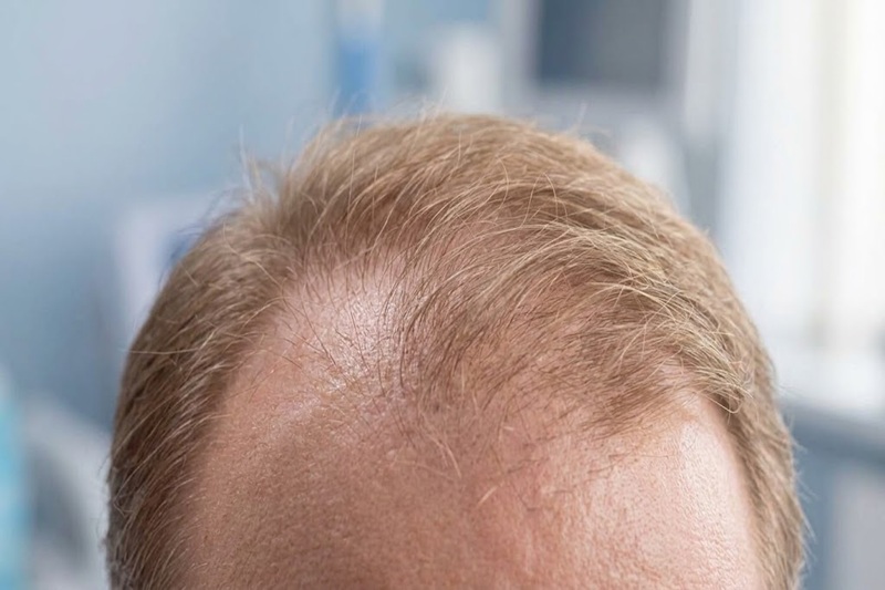 scalp Botox as a treatment for hair loss