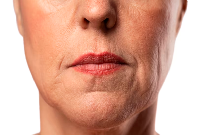 Does Botox Work on Nasolabial Folds?