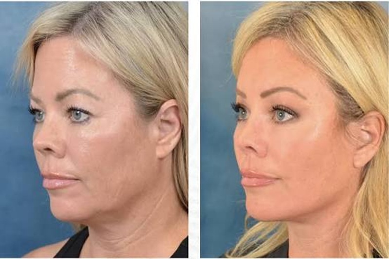 the Differences between Filler vs Facelift