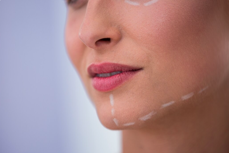 What Treatment Is Best for Nasolabial Folds?