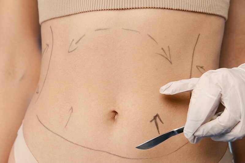 , body contouring may be an option to discuss with a qualified professional.