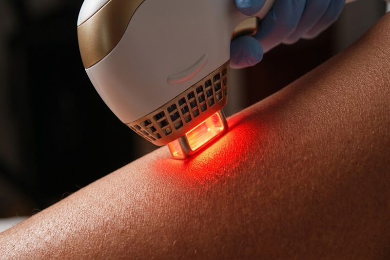 Diode laser hair removal treatment on a woman's leg